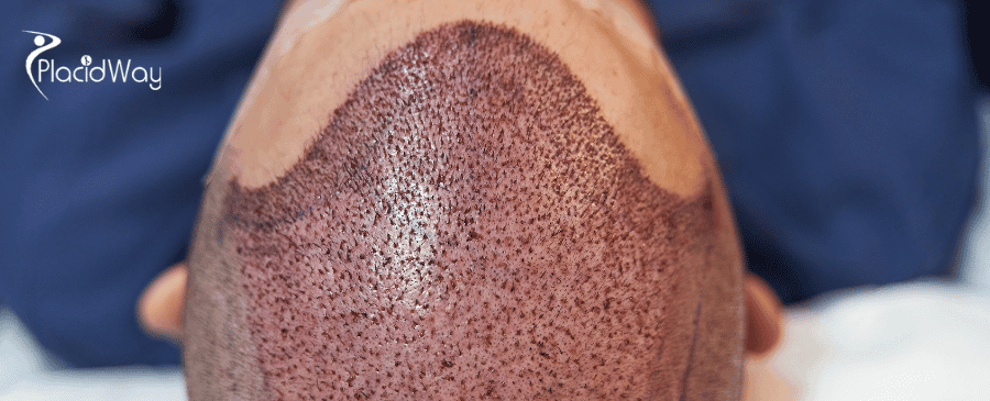 Hair Transplant in Turkey