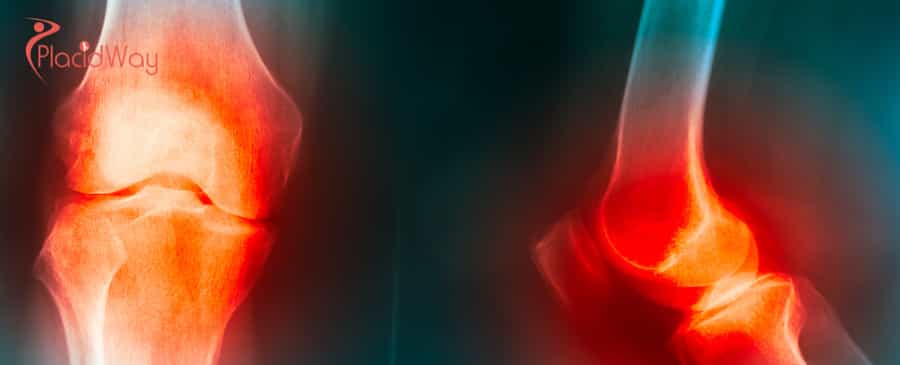 Stem Cell Therapy for Arthritis in Thailand