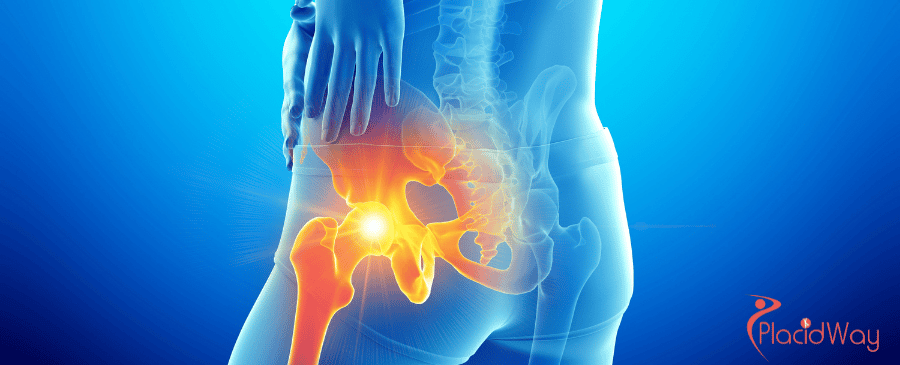Hip Replacement in Turkey