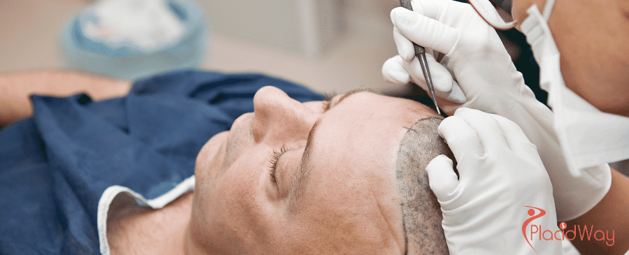 FUE Hair Transplant in Turkey
