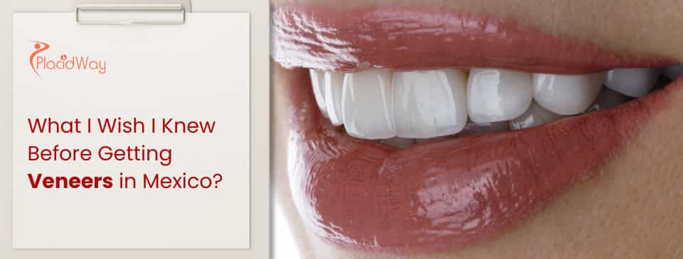 What I Wish I Knew Before Getting Veneers in Mexico?