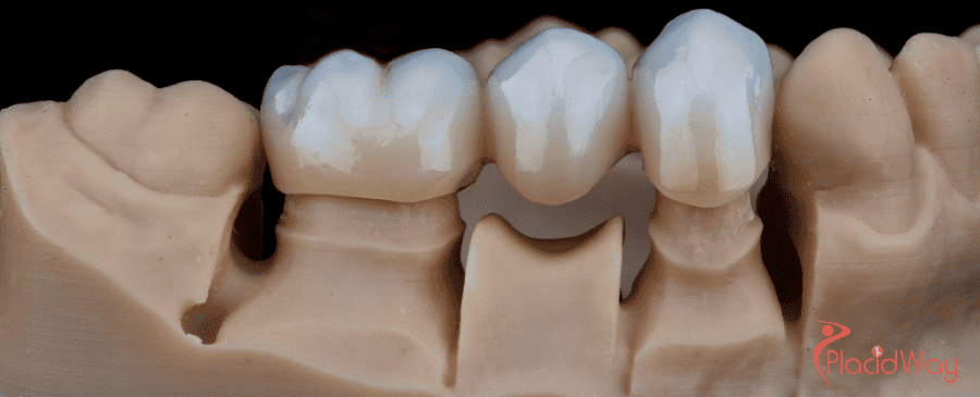 Dental Bridges in Vietnam