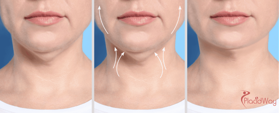 Chin Augmentation Surgery in Thailand