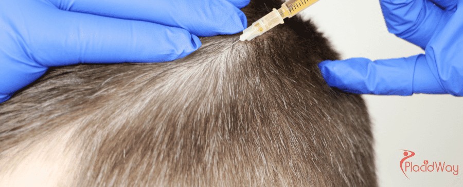 FUE Hair Transplant in Turkey