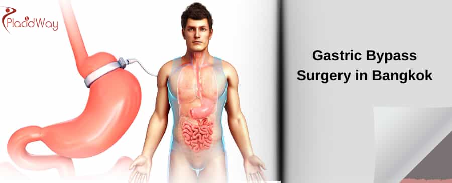Gastric Bypass Surgery in Bangkok