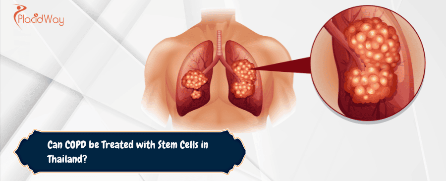 COPD be Treated with Stem Cells in Thailand