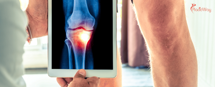Total Knee Replacement in Turkey