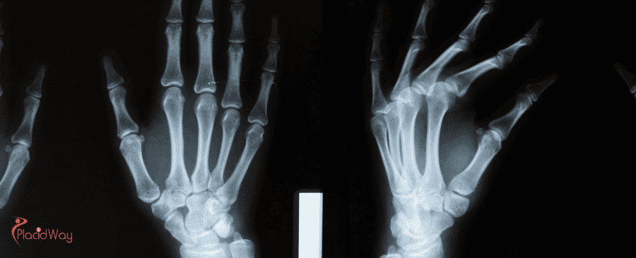 Carpal Tunnel Surgery in Turkey