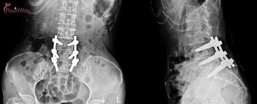 Laminectomy in Turkey