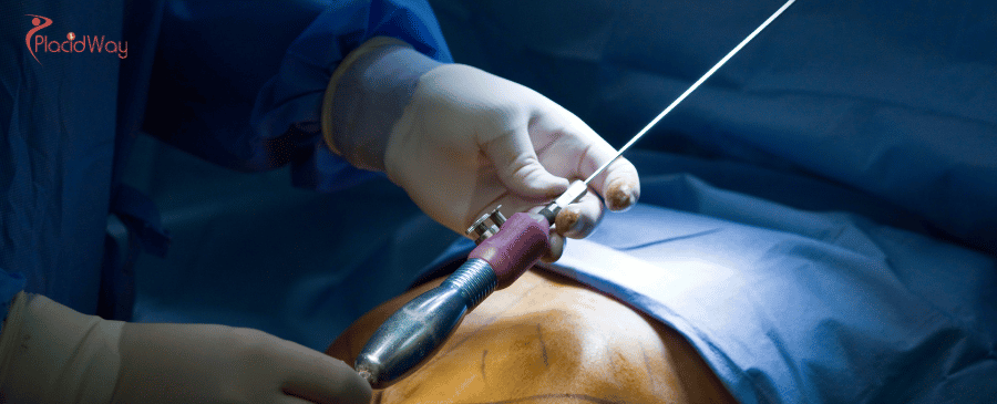 Vaser Liposuction in Istanbul