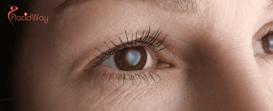 Cataract Surgery in Mexico