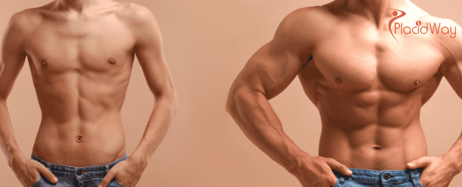 Brustverkleinerung in der Türkei, Gynäkomastie-Operation in der Türkei