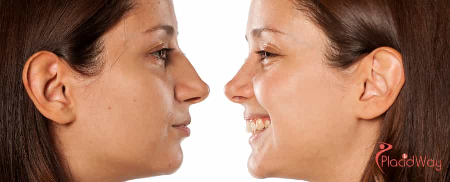 Rhinoplasty in South Korea