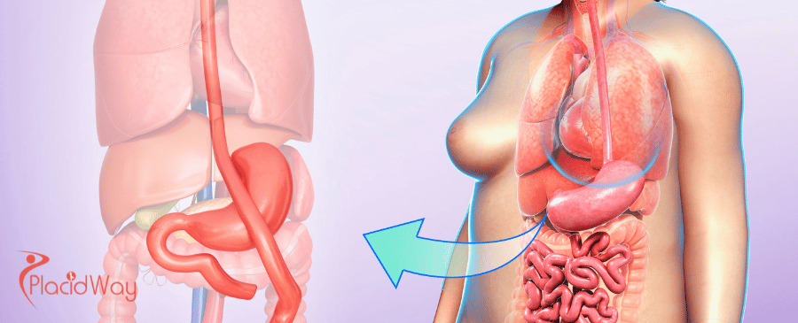 Magenbypass in der Türkei