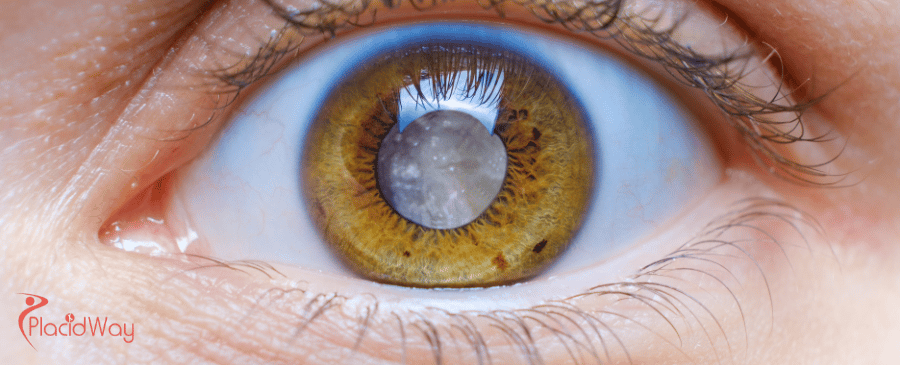 Cataract Surgery in Turkey