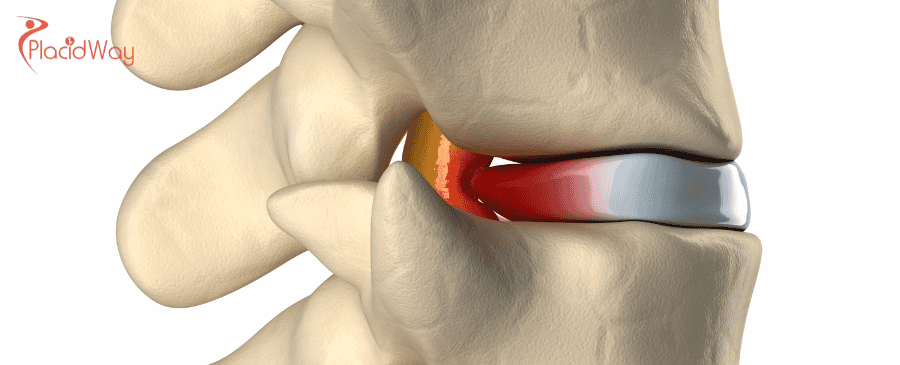 Wirbelsäulenfusion in der Türkei