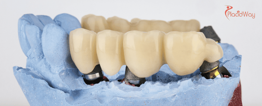 Dental Crowns in Mexico