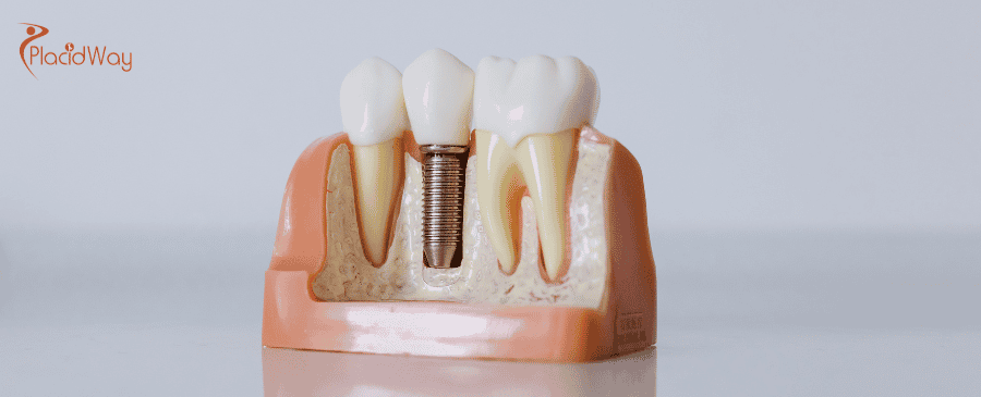 Dental Implants in Costa Rica