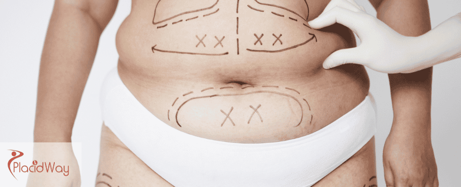 Liposuction in Mexico