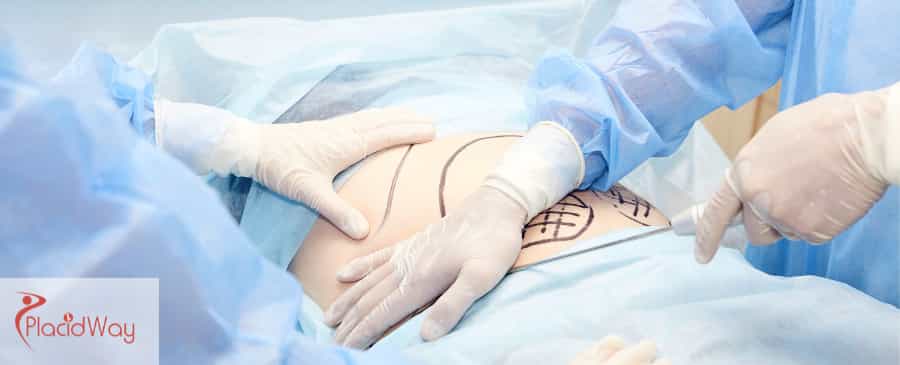 Liposuction in Mexico