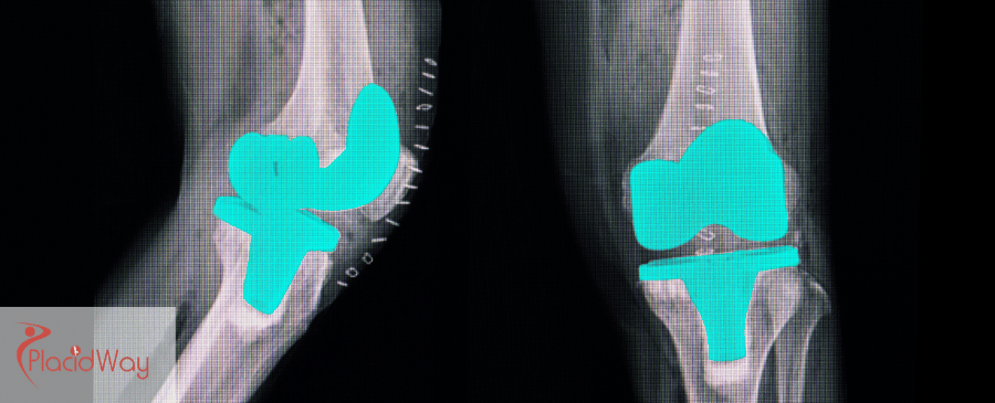 knee replacement surgery in Mexico