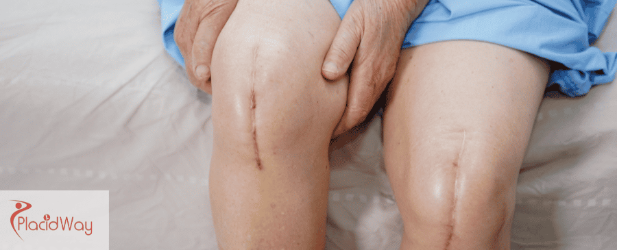 knee replacement surgery in Mexico
