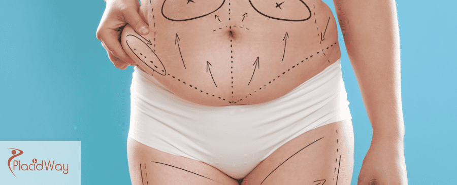Tummy Tuck Surgery in Mexico