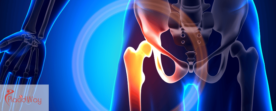 Joint Arthroscopy in Mexico