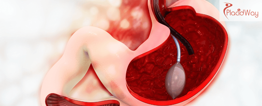 Magenballon in der Türkei