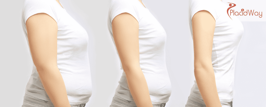 Magenballon in der Türkei