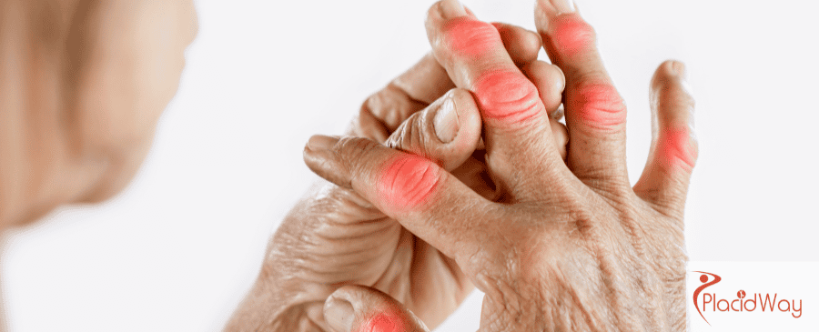 Stem Cell Therapy for Arthritis in Mexico