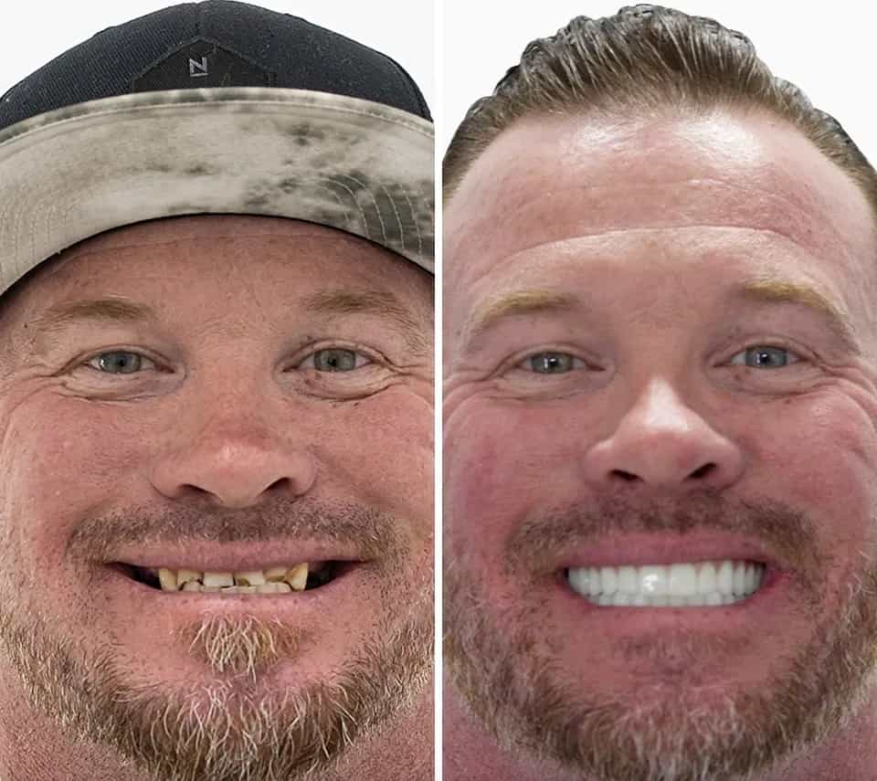 Before and After All on 4 Dental Implants in Los Algodones Mexico