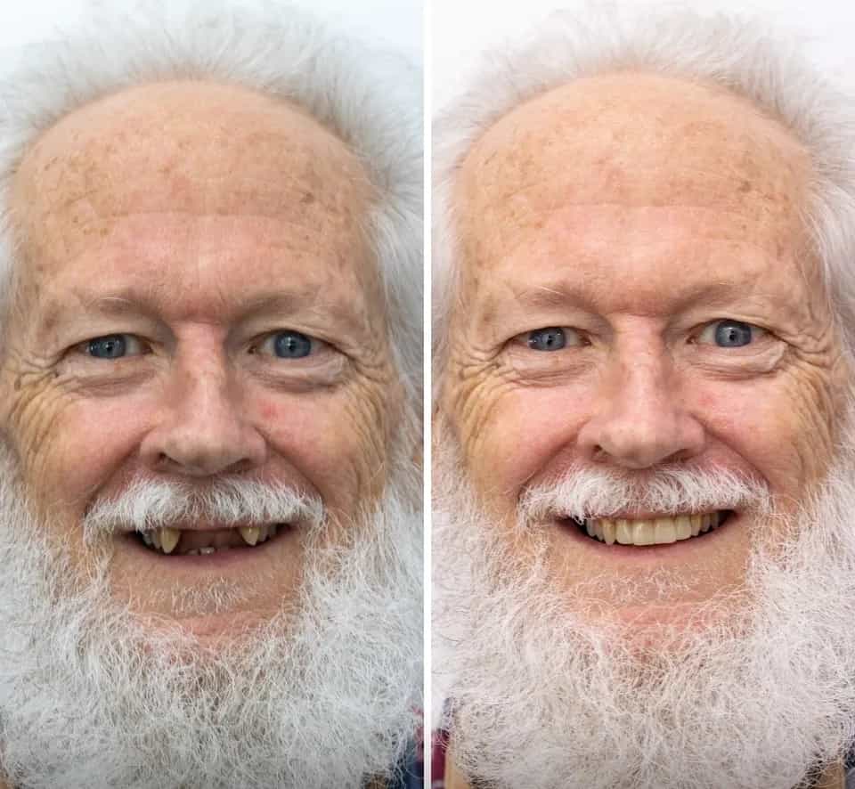 Before and After Dental Bridges over Implants in Los Algodones Mexico