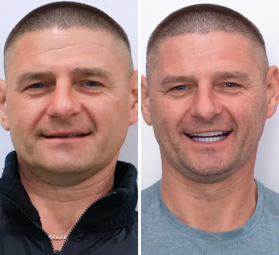 Before and After Dental Veneers and Root Canal in Los Algodones Mexico