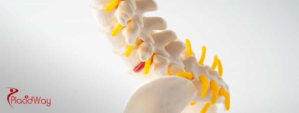 Künstlicher Bandscheibenersatz in der Türkei