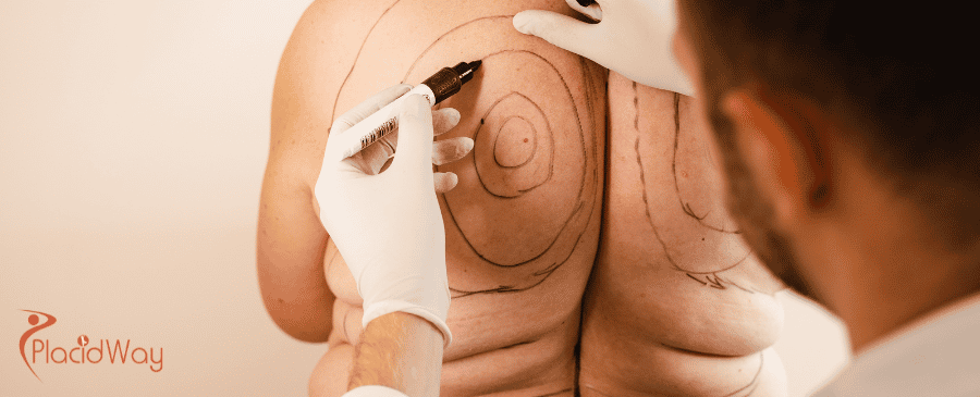 Liposuction in Thailand