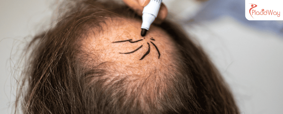 hair transplant in Turkey