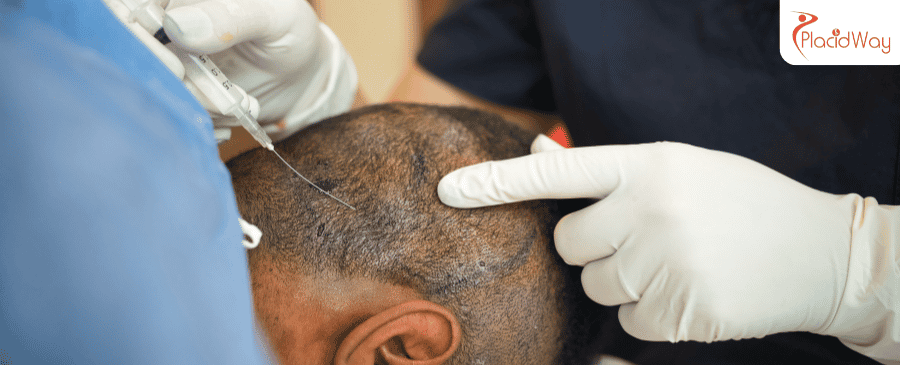 hair transplant in Turkey