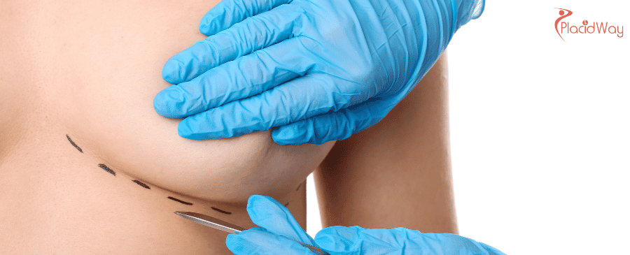 Breast Augmentation in Turkey