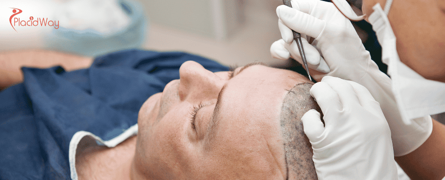 Hair Transplant Costs in Turkey