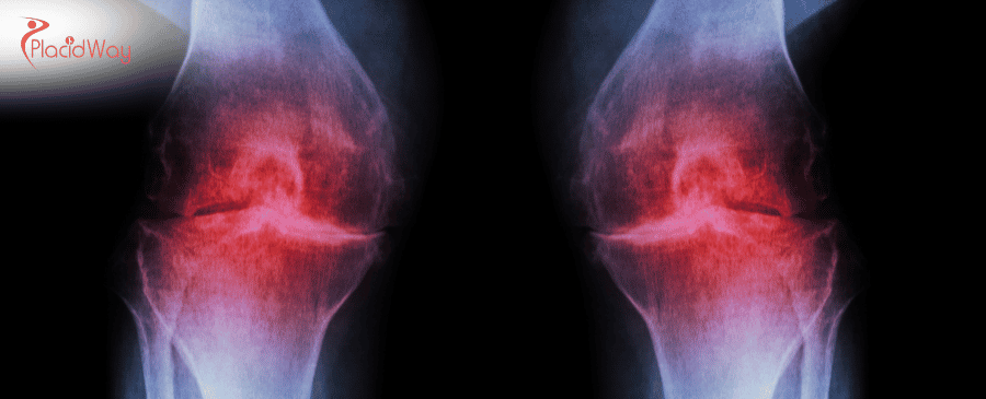 Stem Cell Therapy for Osteoarthritis in Turkey