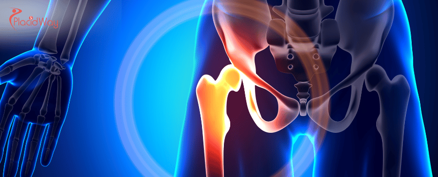 Totaler Hüftersatz in Mexiko