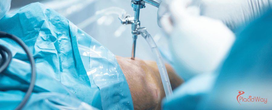 ACL Reconstruction Surgery in Turkey