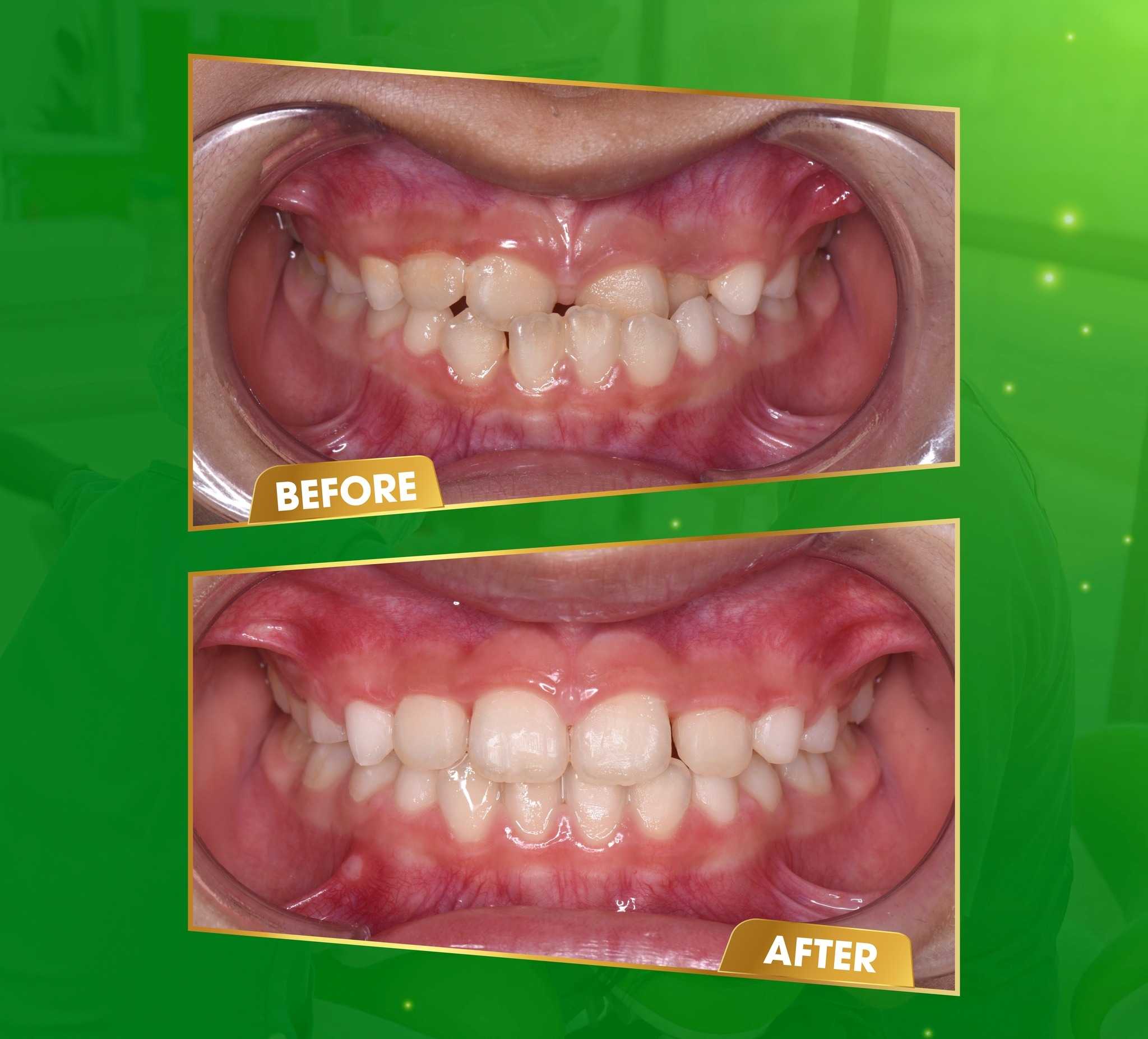 Before and After Dental Clinic in Vietnam - Da Nang Implant Dental Center