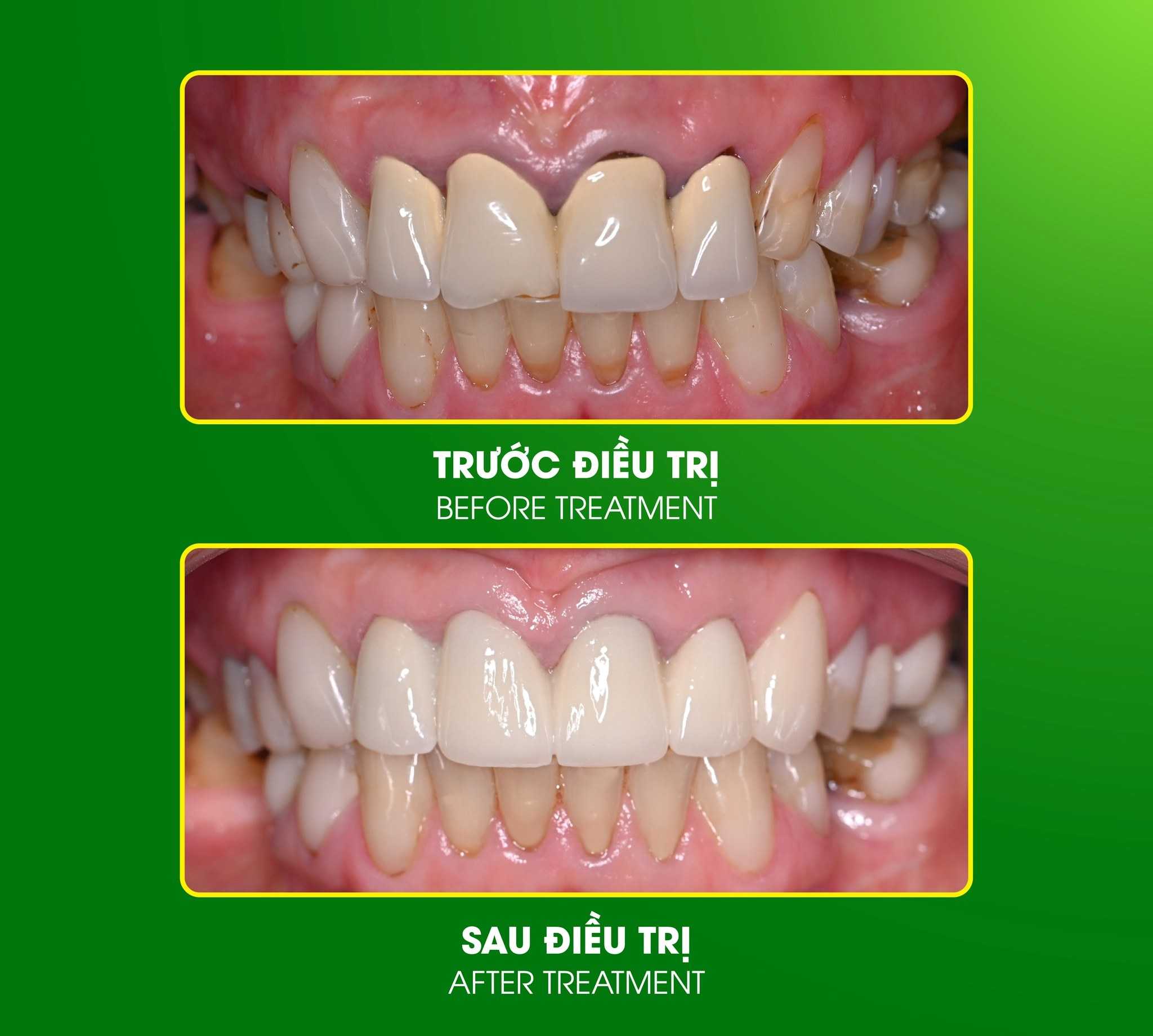 Before and After Dental Clinic in Vietnam - Da Nang Implant Clinic