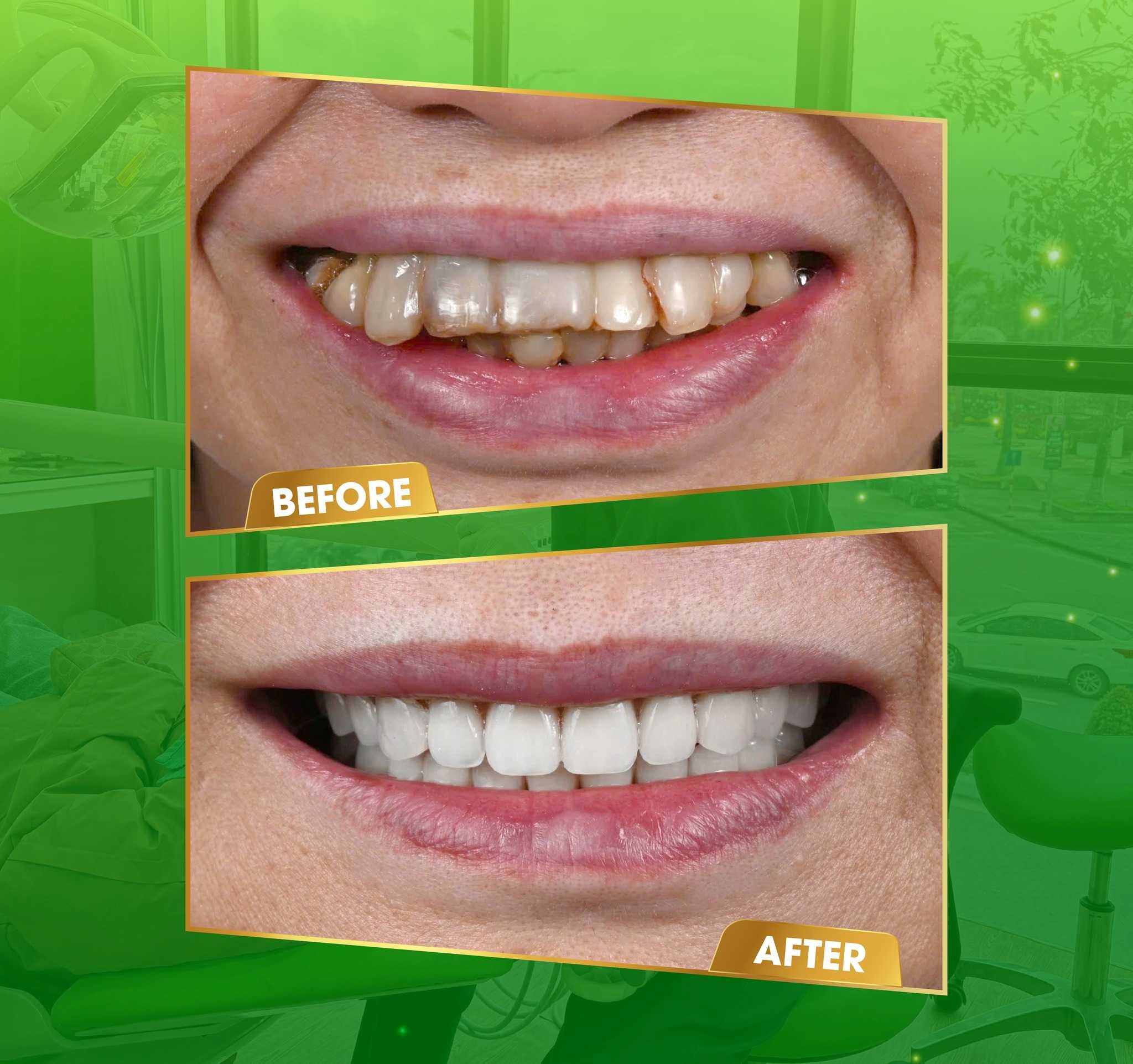 Before and After Dental Clinic in Vietnam Da Nang Implant Dental Center