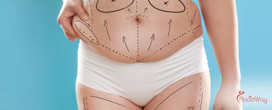 Tummy Tuck in Thailand