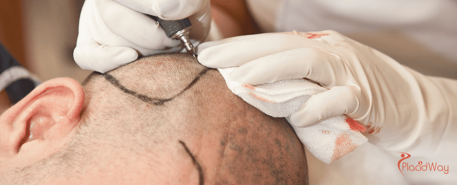 DHI Hair Transplant in Turkey