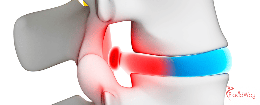 Affordable Spine Surgery Discectomy in Turkey
