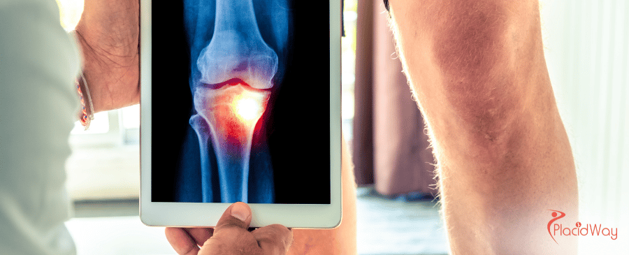 Affordable Arthroscopic Surgery in Turkey